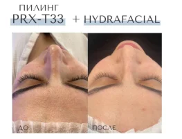 HydraFacial — расширенный протокол для лица и шеи